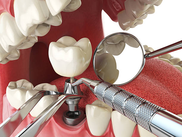 Best Dentist for Tooth Abscess  in Bemidji, MN